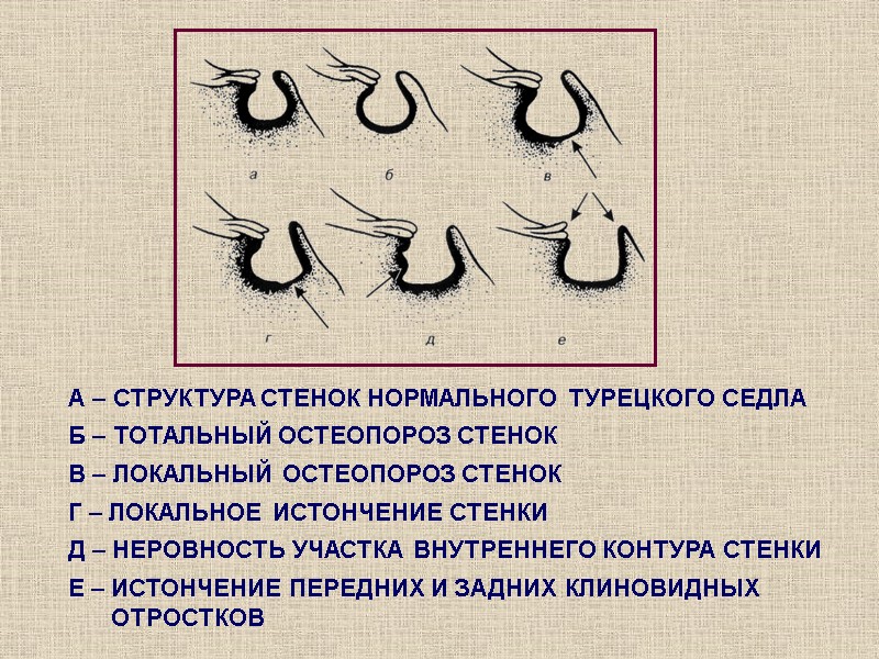 А – СТРУКТУРА СТЕНОК НОРМАЛЬНОГО ТУРЕЦКОГО СЕДЛА Б – ТОТАЛЬНЫЙ ОСТЕОПОРОЗ СТЕНОК В –